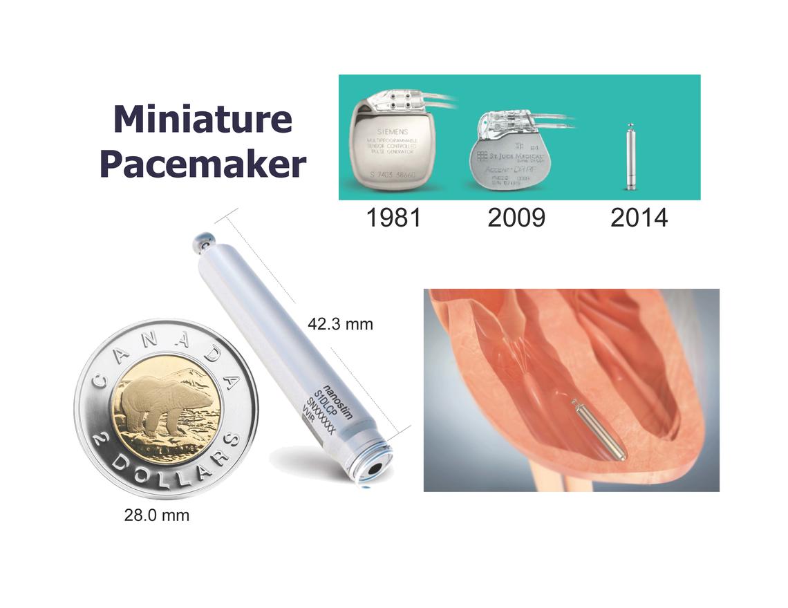 The leadless pacemaker is inserted through a small incision in the groin and guided by X-rays into the right lower heart chamber. It is expected to last an average of 15 years in the patient. 