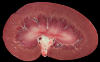 Kidney1