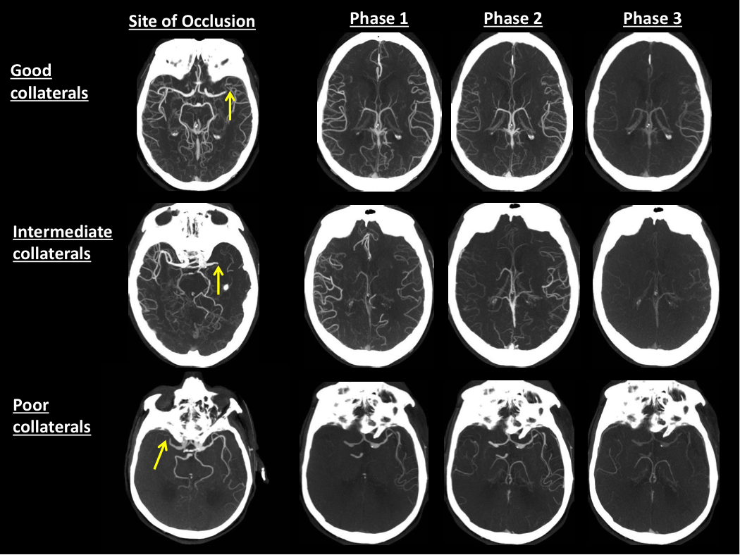 Multi-phase CTA scans showing patients with stroke (blockage indicated by the arrow) and examples of patients with good collaterals (top) and poor collaterals (bottom). Patients with good collaterals tend to have better outcomes following stroke, because brain blood flow is preserved.